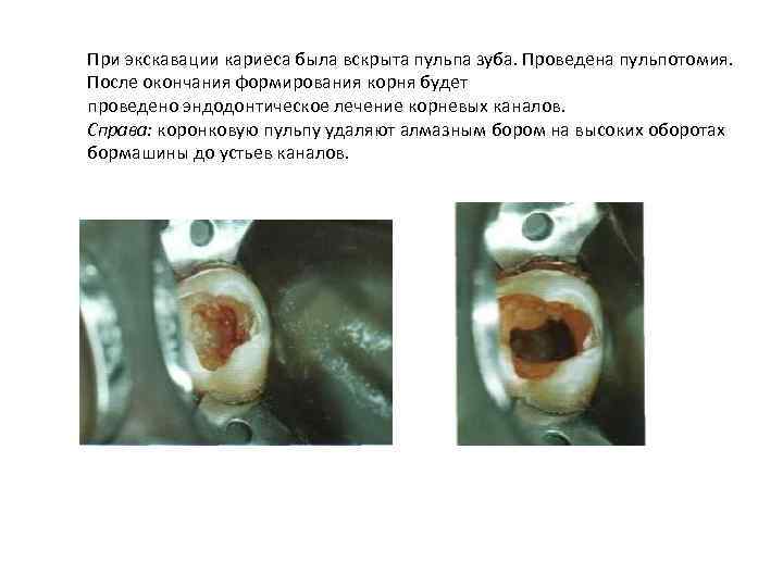 При экскавации кариеса была вскрыта пульпа зуба. Проведена пульпотомия. После окончания формирования корня будет
