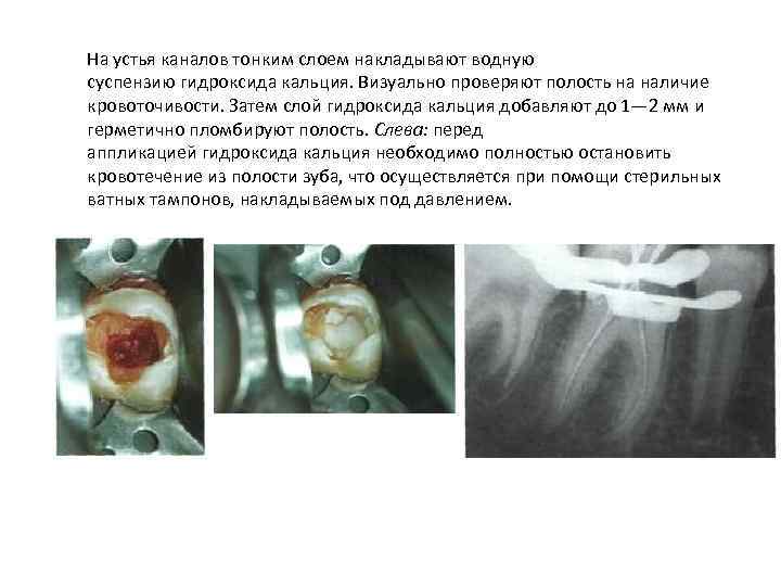 На устья каналов тонким слоем накладывают водную суспензию гидроксида кальция. Визуально проверяют полость на