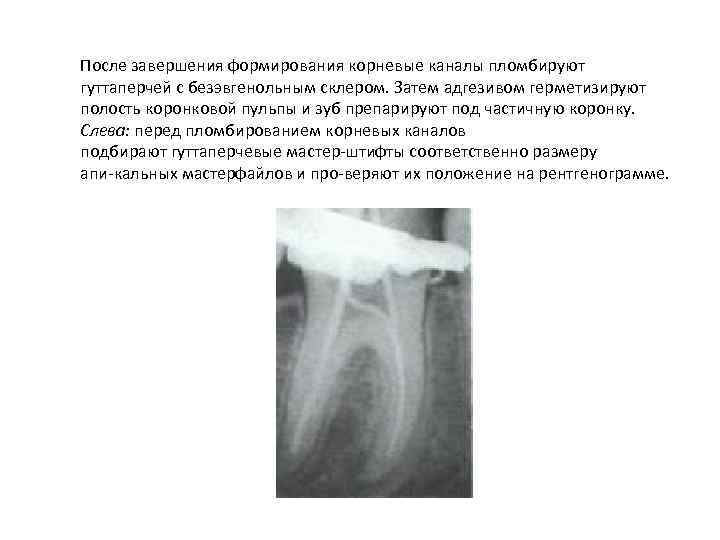 После завершения формирования корневые каналы пломбируют гуттаперчей с безэвгенольным склером. Затем адгезивом герметизируют полость