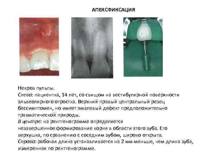 АПЕКСФИКСАЦИЯ Некроз пульпы. Слева: пациентка, 14 лет, со свищом на вестибулярной поверхности альвеолярного отростка.