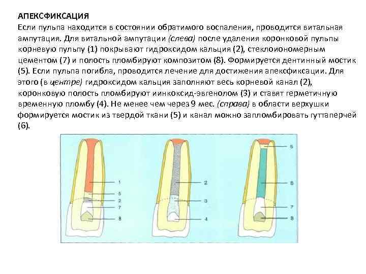 АПЕКСФИКСАЦИЯ Если пульпа находится в состоянии обратимого воспаления, проводится витальная ампутация. Для витальной ампутации