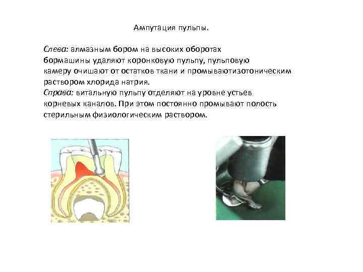 Ампутация пульпы. Слева: алмазным бором на высоких оборотах бормашины удаляют коронковую пульпу, пульповую камеру