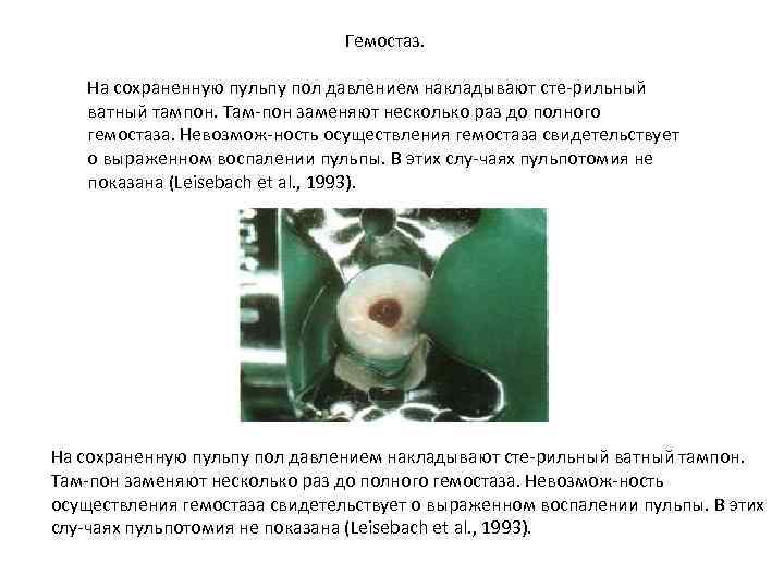 Гемостаз. На сохраненную пульпу пол давлением накладывают сте рильный ватный тампон. Там пон заменяют