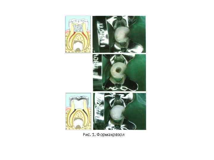 Рис. 1. Формакрезол 