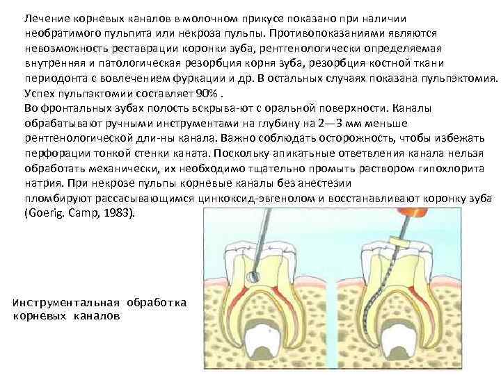 Лечение корневых каналов в молочном прикусе показано при наличии необратимого пульпита или некроза пульпы.