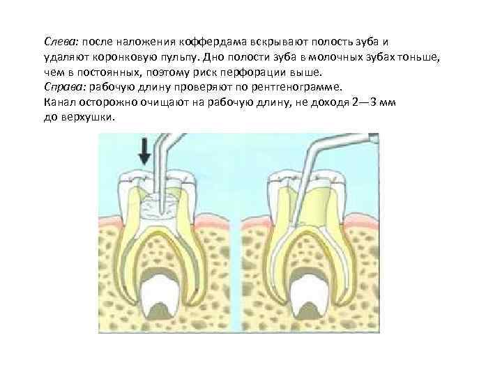 Слева: после наложения коффердама вскрывают полость зуба и удаляют коронковую пульпу. Дно полости зуба