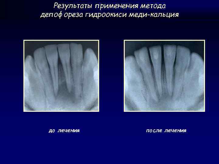 Результаты применения метода депофореза гидроокиси меди-кальция до лечения после лечения 