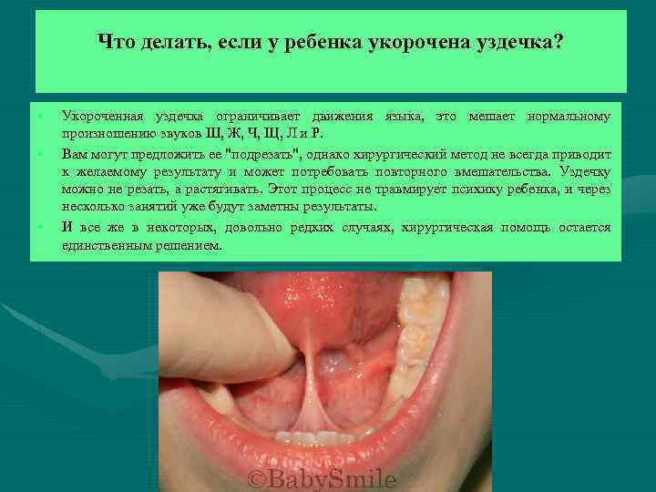 Что делать, если у ребенка укорочена уздечка? • • • Укороченная уздечка ограничивает движения