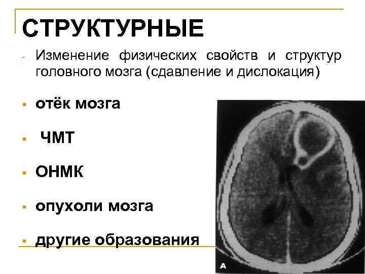 СТРУКТУРНЫЕ - § Изменение физических свойств и структур головного мозга (сдавление и дислокация) отёк