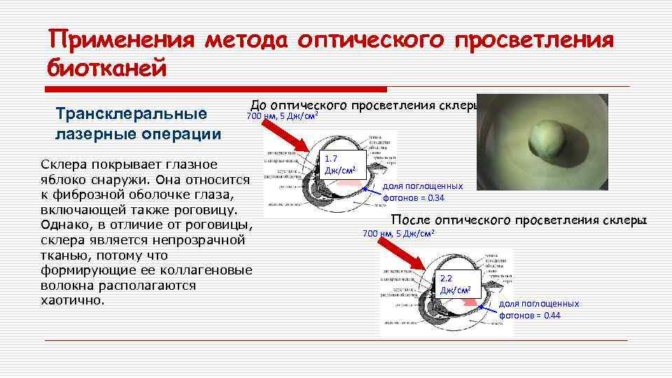 Применения метода оптического просветления биотканей Трансклеральные лазерные операции До оптического просветления склеры 700 нм,