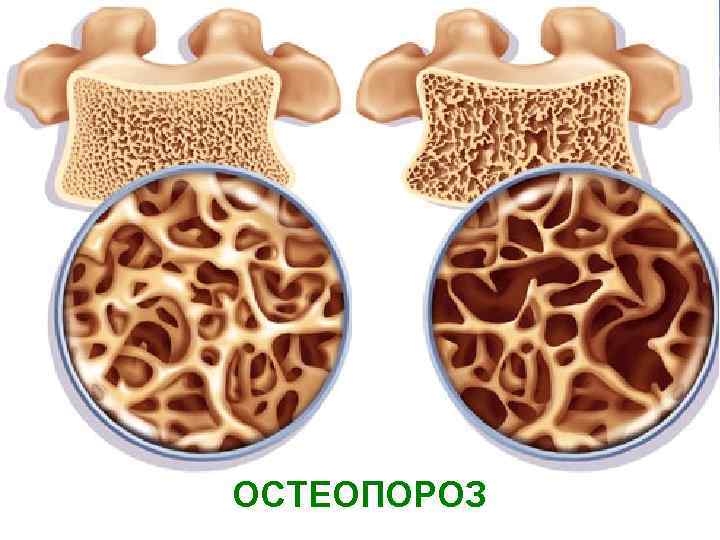 ОСТЕОПОРОЗ 