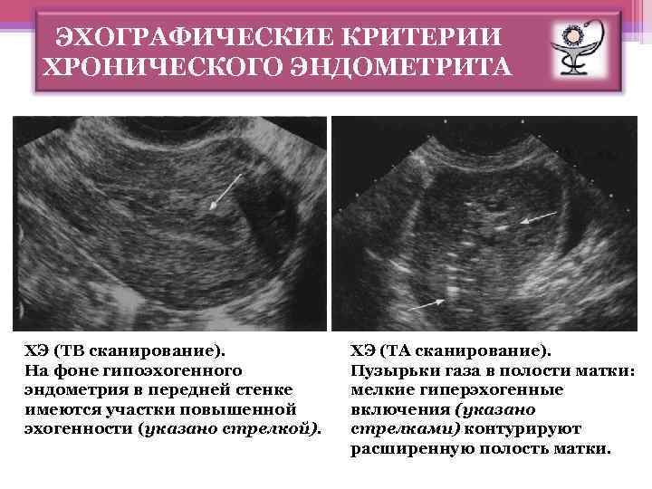 ЭХОГРАФИЧЕСКИЕ КРИТЕРИИ ХРОНИЧЕСКОГО ЭНДОМЕТРИТА ХЭ (ТВ сканирование). На фоне гипоэхогенного эндометрия в передней стенке