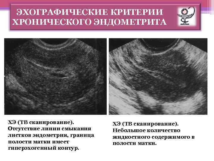 Расширение полости матки. Гиперплазия эндометрия полипоз эндометрия).. Послеродовый эндометрит УЗИ. Гиперэхогенный полип эндометрия.