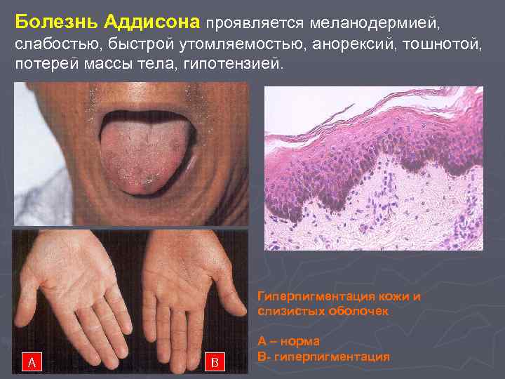 Болезнь Аддисона проявляется меланодермией, слабостью, быстрой утомляемостью, анорексий, тошнотой, потерей массы тела, гипотензией. Гиперпигментация