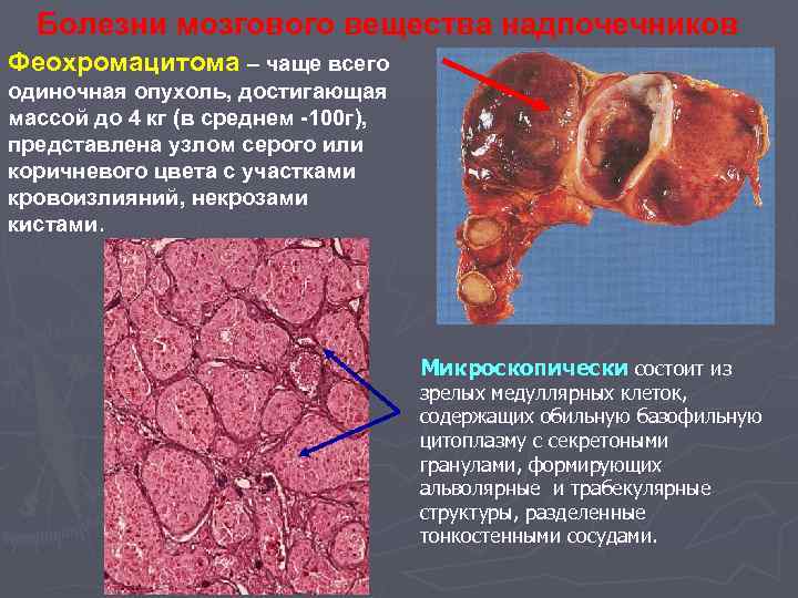 Болезни мозгового вещества надпочечников Феохромацитома – чаще всего одиночная опухоль, достигающая массой до 4