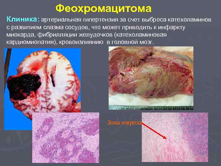 Феохромацитома Клиника: артериальная гипертензия за счет выброса катехоламинов с развитием спазма сосудов, что может