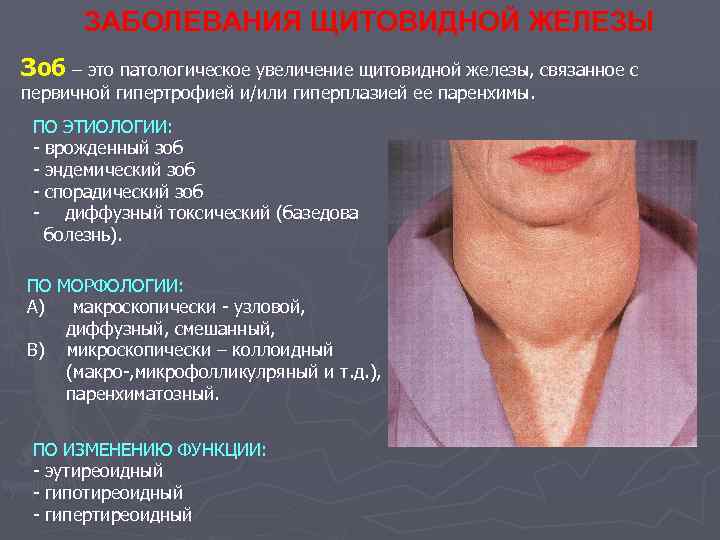 ЗАБОЛЕВАНИЯ ЩИТОВИДНОЙ ЖЕЛЕЗЫ Зоб – это патологическое увеличение щитовидной железы, связанное с первичной гипертрофией
