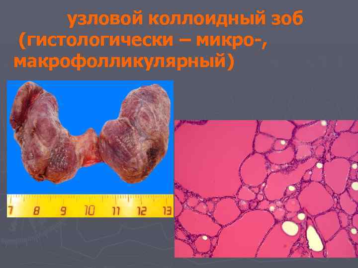 узловой коллоидный зоб (гистологически – микро-, макрофолликулярный) 