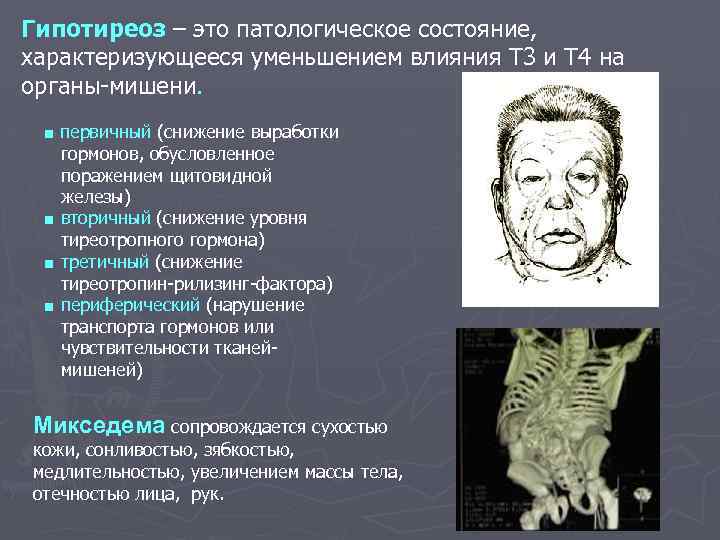 Гипотиреоз – это патологическое состояние, характеризующееся уменьшением влияния Т 3 и Т 4 на