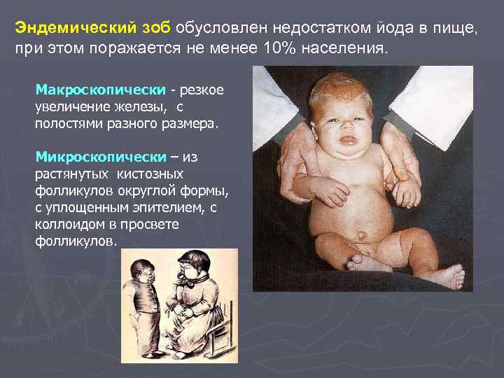 Эндемический зоб обусловлен недостатком йода в пище, при этом поражается не менее 10% населения.