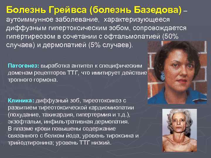 Болезнь Грейвса (болезнь Базедова) – аутоиммунное заболевание, характеризующееся диффузным гипертоксическим зобом, сопровождается гипертиреозом в