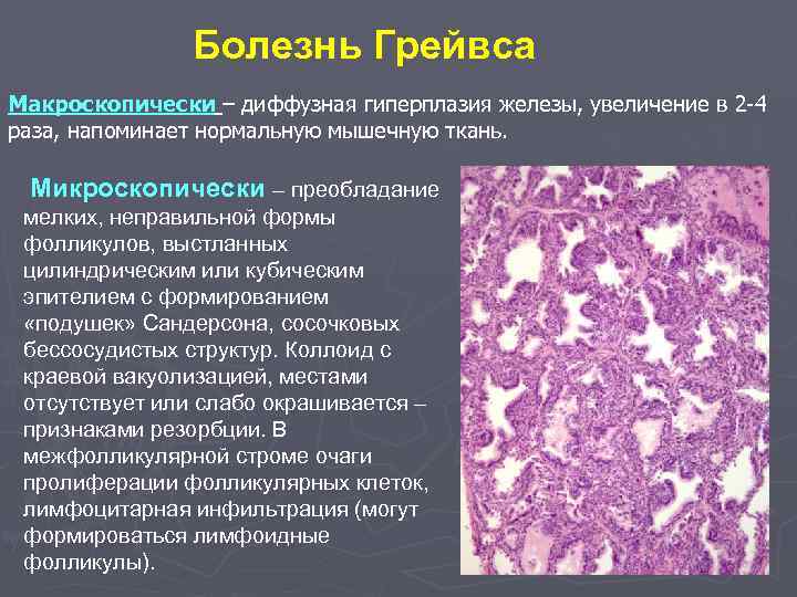 Болезнь Грейвса Макроскопически – диффузная гиперплазия железы, увеличение в 2 -4 раза, напоминает нормальную