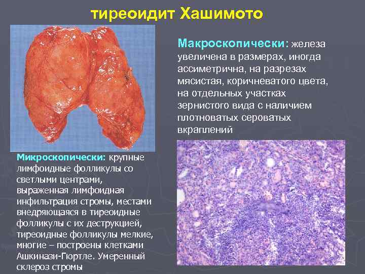 тиреоидит Хашимото Макроскопически: железа увеличена в размерах, иногда ассиметрична, на разрезах мясистая, коричневатого цвета,