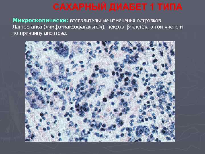 САХАРНЫЙ ДИАБЕТ 1 ТИПА Микроскопически: воспалительные изменения островков Лангерганса (лимфо-макрофагальная), некроз β-клеток, в том