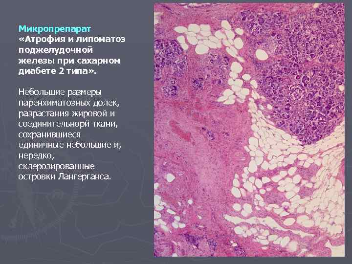 Микропрепарат «Атрофия и липоматоз поджелудочной железы при сахарном диабете 2 типа» . Небольшие размеры