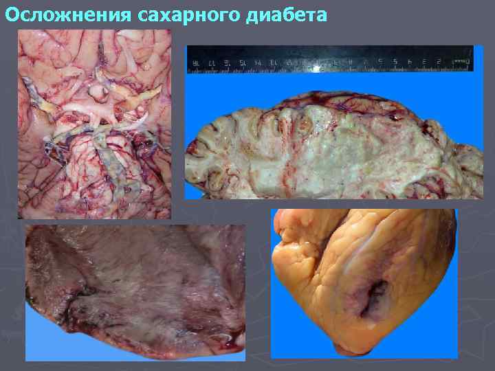 Осложнения сахарного диабета 