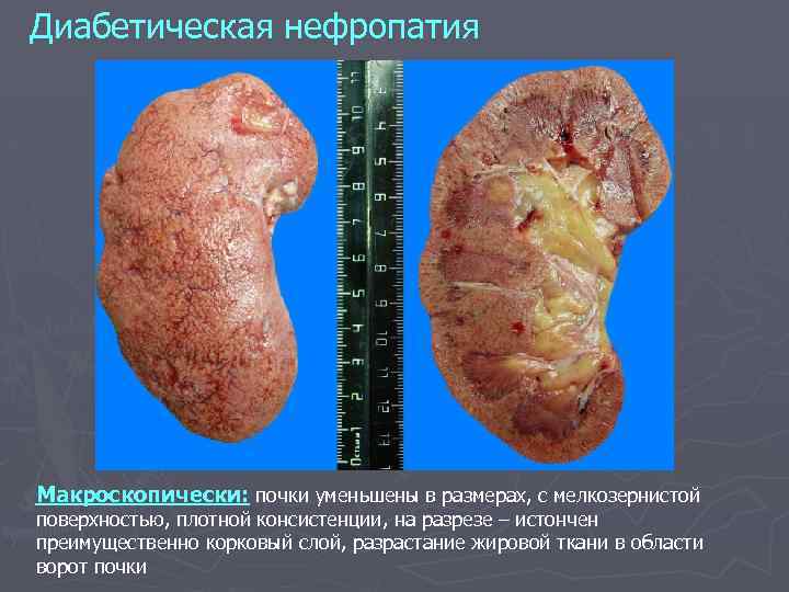 Диабетическая нефропатия Макроскопически: почки уменьшены в размерах, с мелкозернистой поверхностью, плотной консистенции, на разрезе