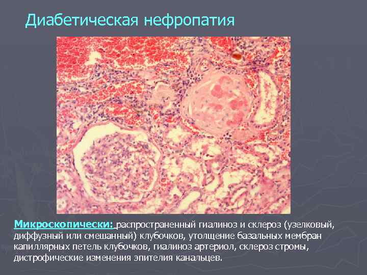 Диабетическая нефропатия Микроскопически: распространенный гиалиноз и склероз (узелковый, диффузный или смешанный) клубочков, утолщение базальных