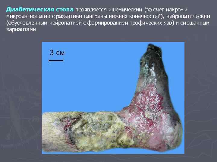 Диабетическая стопа проявляется ишемическим (за счет макро- и микроангиопатии с развитием гангрены нижних конечностей),