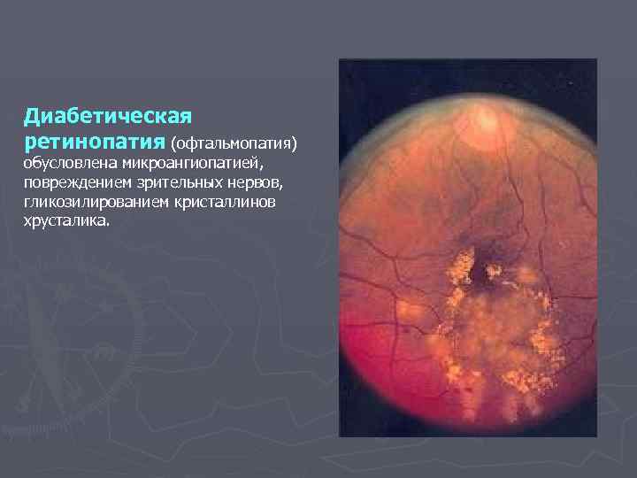 Диабетическая ретинопатия (офтальмопатия) обусловлена микроангиопатией, повреждением зрительных нервов, гликозилированием кристаллинов хрусталика. 