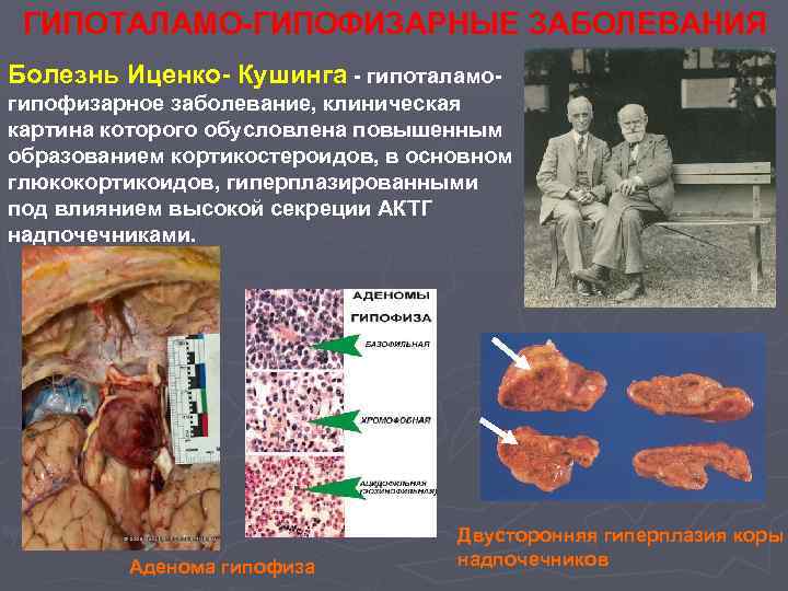 ГИПОТАЛАМО-ГИПОФИЗАРНЫЕ ЗАБОЛЕВАНИЯ Болезнь Иценко- Кушинга - гипоталамогипофизарное заболевание, клиническая картина которого обусловлена повышенным образованием
