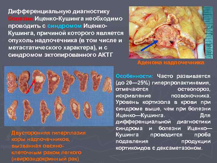Дифференциальную диагностику болезни Иценко-Кушинга необходимо проводить с синдромом Иценко. Кушинга, причиной которого является опухоль