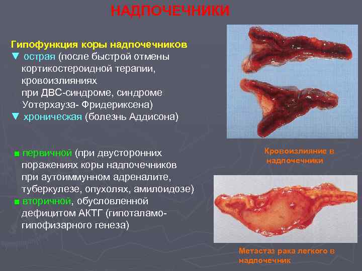 НАДПОЧЕЧНИКИ Гипофункция коры надпочечников ▼ острая (после быстрой отмены кортикостероидной терапии, кровоизлияниях при ДВС-синдроме,