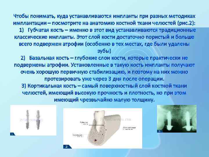Чтобы понимать, куда устанавливаются импланты при разных методиках имплантации – посмотрите на анатомию костной
