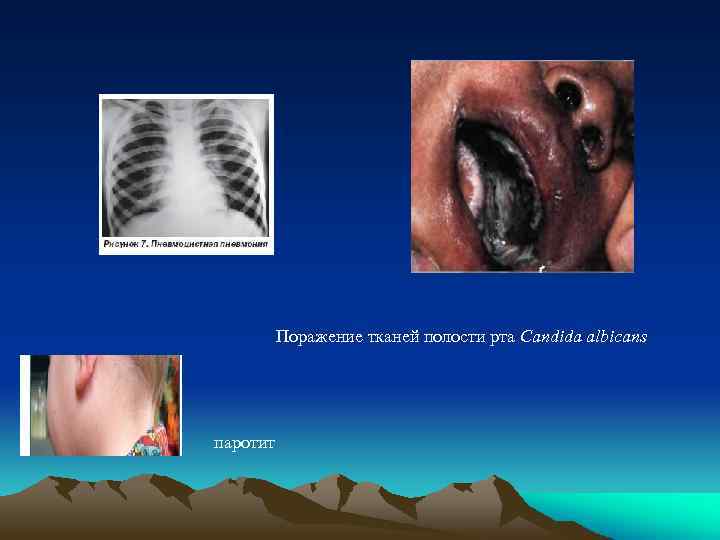 Поражение тканей полости рта Candida albicans паротит 