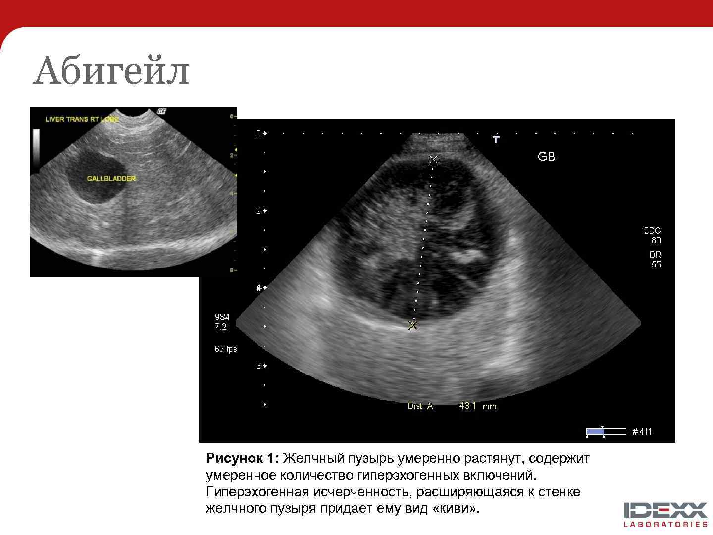 Абигейл Рисунок 1: Желчный пузырь умеренно растянут, содержит умеренное количество гиперэхогенных включений. Гиперэхогенная исчерченность,