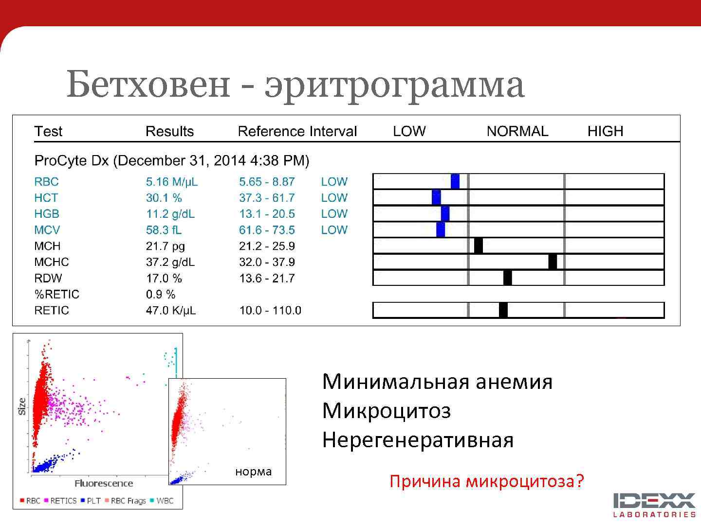 Бетховен - эритрограмма Минимальная анемия Микроцитоз Нерегенеративная норма Причина микроцитоза? 