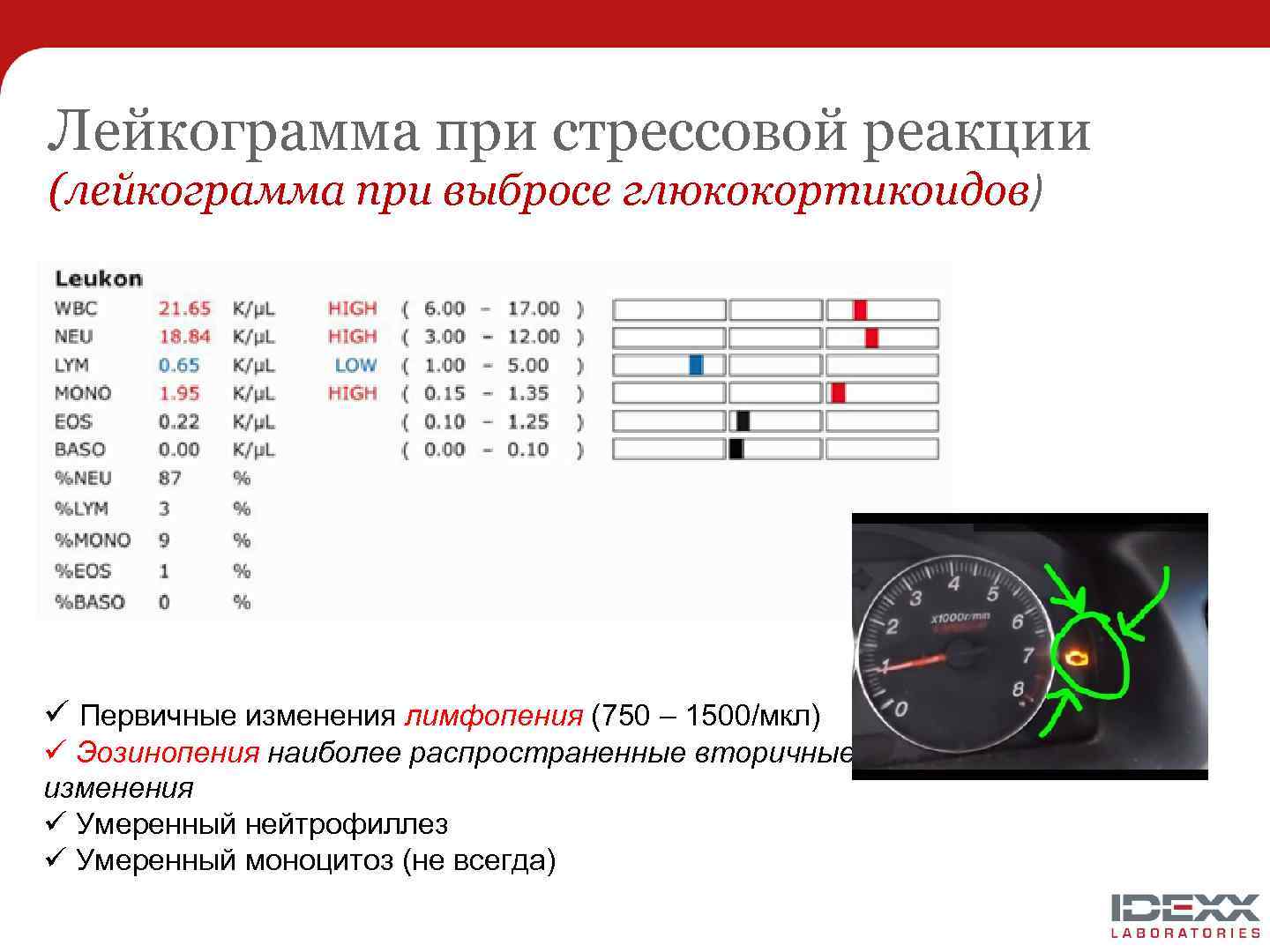Лейкограмма при стрессовой реакции (лейкограмма при выбросе глюкокортикоидов) ü Первичные изменения лимфопения (750 –