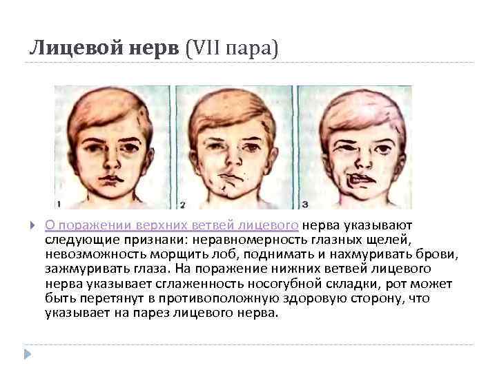 Лицевой нерв (VII пара) О поражении верхних ветвей лицевого нерва указывают следующие признаки: неравномерность