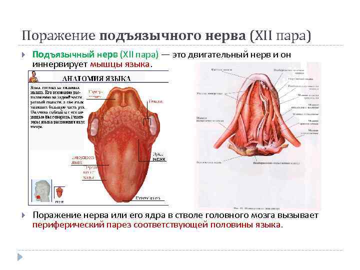 Поражение подъязычного нерва (XII пара) Подъязычный нерв (XII пара) — это двигательный нерв и