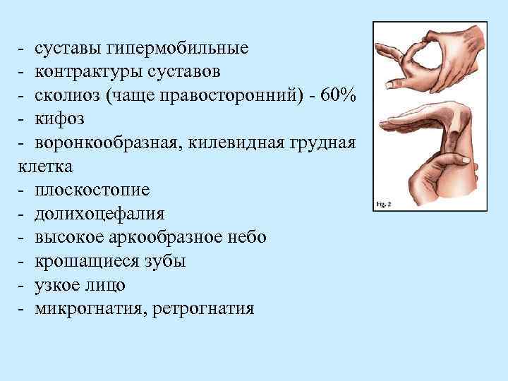 - суставы гипермобильные - контрактуры суставов - сколиоз (чаще правосторонний) - 60% - кифоз