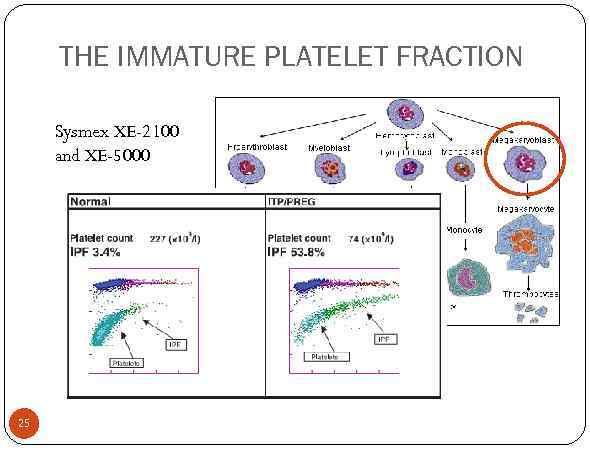 THE IMMATURE PLATELET FRACTION Sysmex XE-2100 and XE-5000 25 