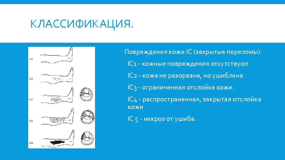 КЛАССИФИКАЦИЯ. Повреждения кожи IC (закрытые переломы): IC 1 кожные повреждения отсутствуют. IC 2 кожа