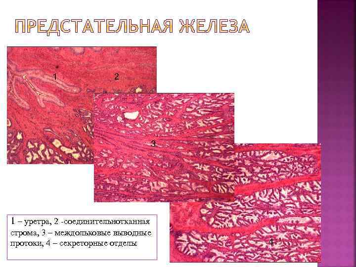 1 2 3 1 – уретра, 2 -соединительнотканная строма, 3 – междольковые выводные протоки,