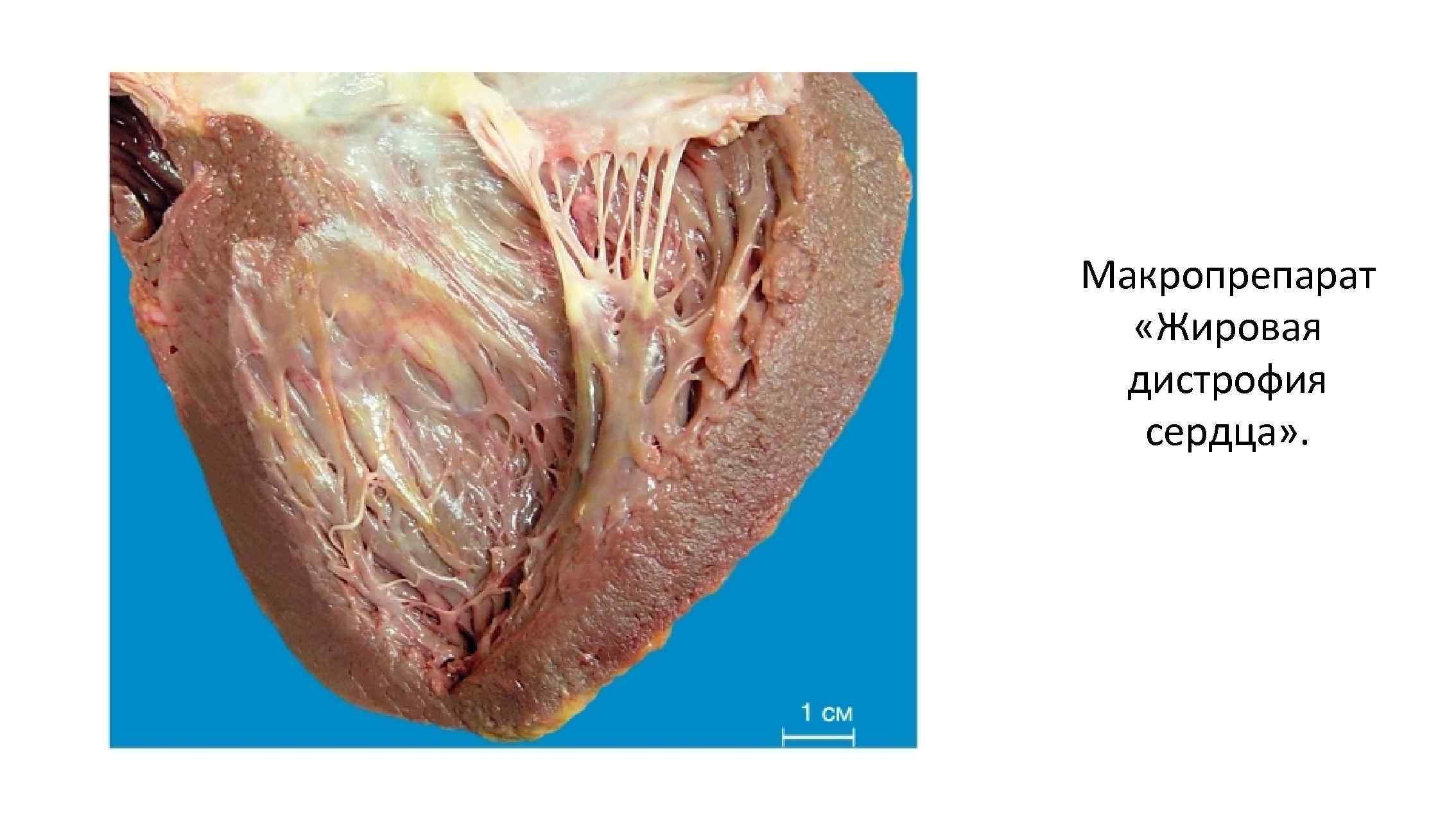 Макропрепарат «Жировая дистрофия сердца» . 