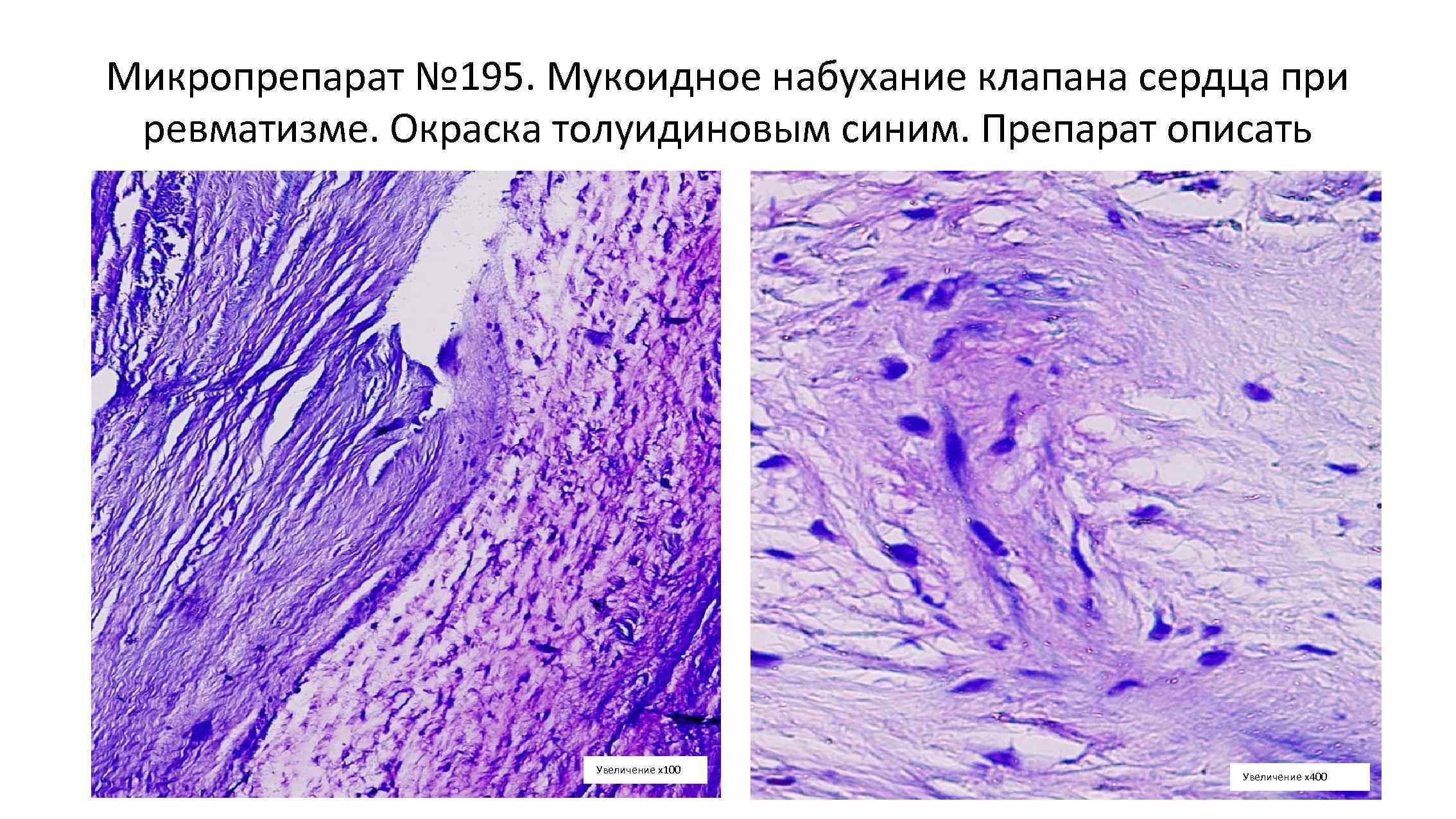 Микропрепарат № 195. Мукоидное набухание клапана сердца при ревматизме. Окраска толуидиновым синим. Препарат описать